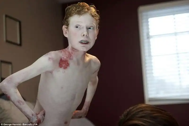 jonathan pitre ha la pelle piu delicata del mondo