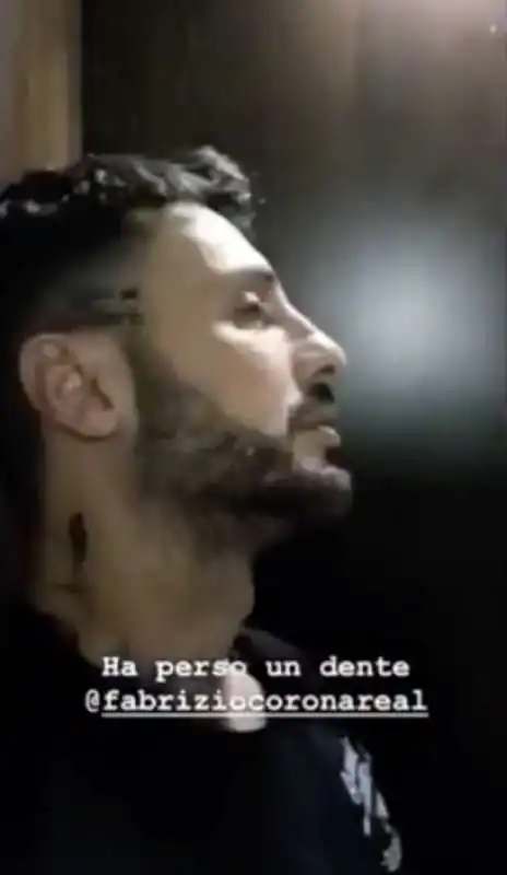 fabrizio corona perde un dente al ristorante e lo ritrova nella spazzatura 7