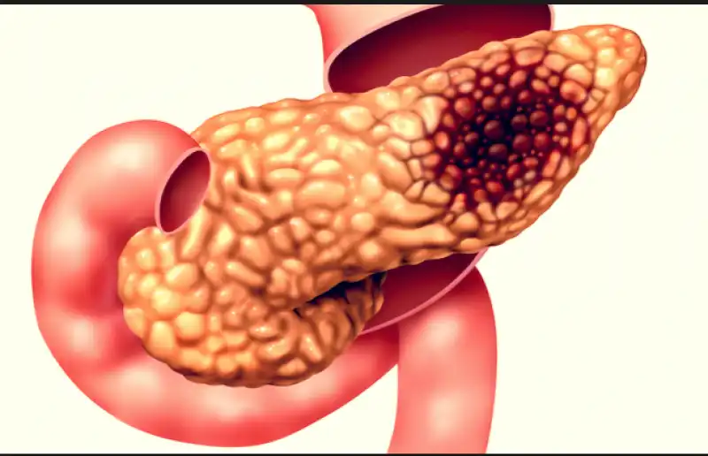 tumore pancreas