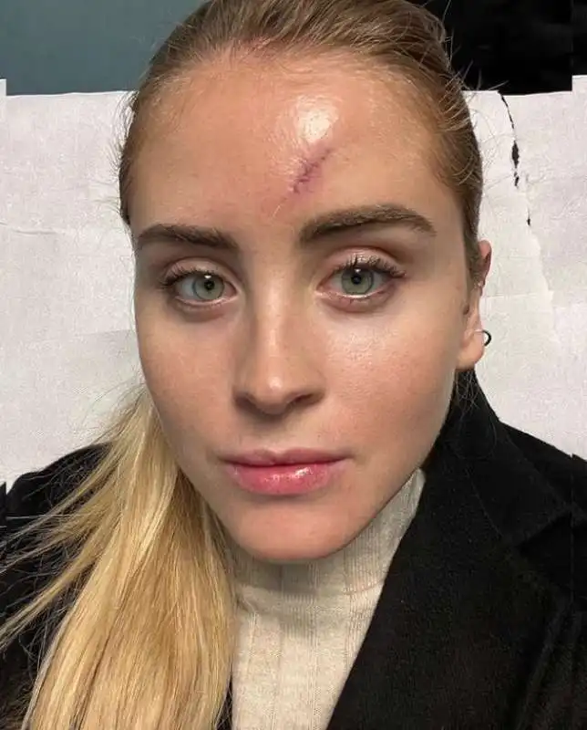 valentina ferragni e il carcinoma 1