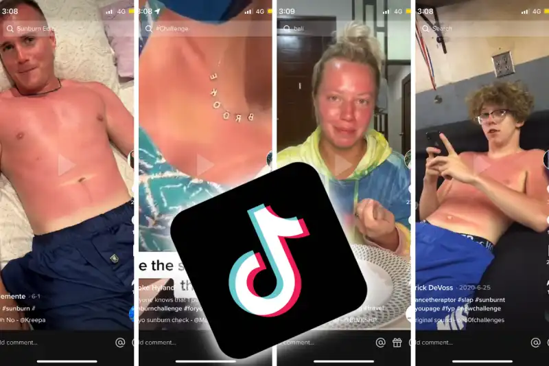 SUNBURN CHALLENGE