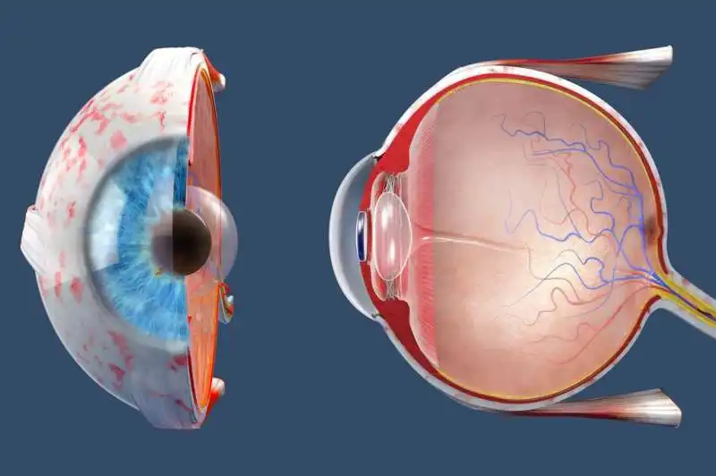 distacco della retina 2