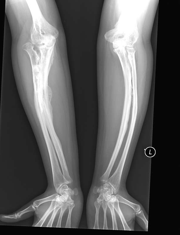 osteogenesi imperfetta 2