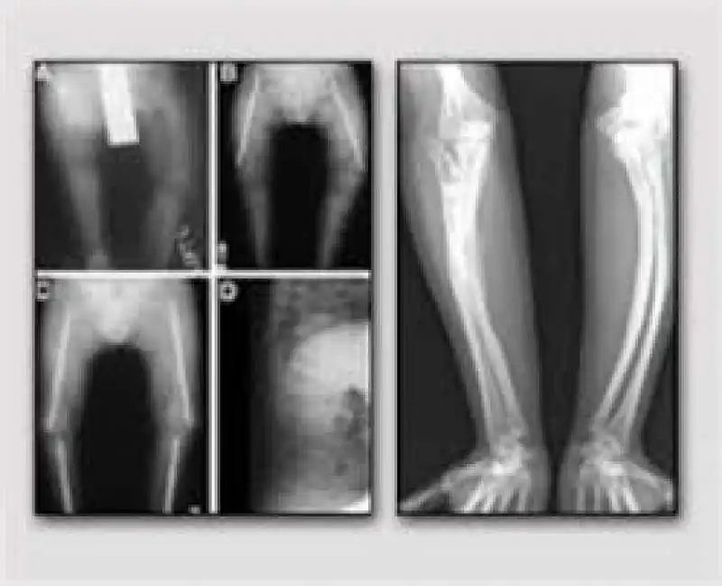 osteogenesi imperfetta 3