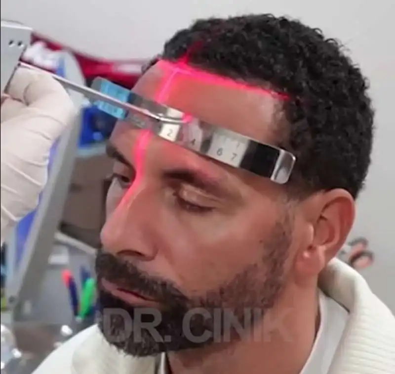 rio ferdinand trapianto di capelli