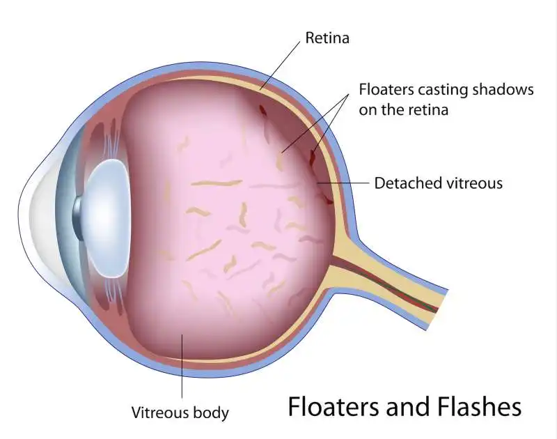 mosche volanti nel campo visivo 1