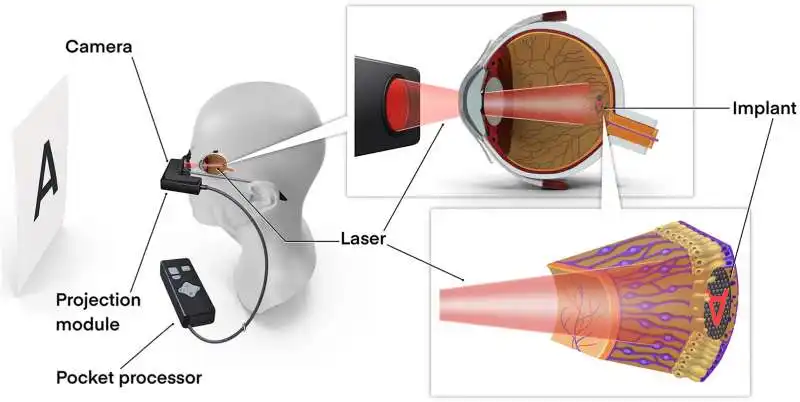 RETINA ARTIFICIALE PRIMA  