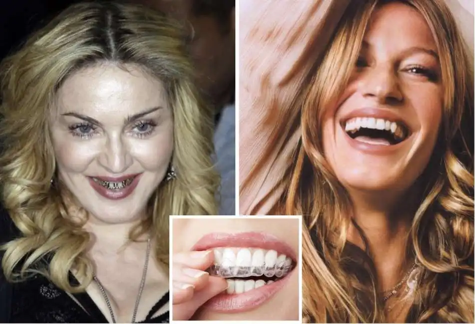 madonna gisele bundchen aligner apparecchio denti