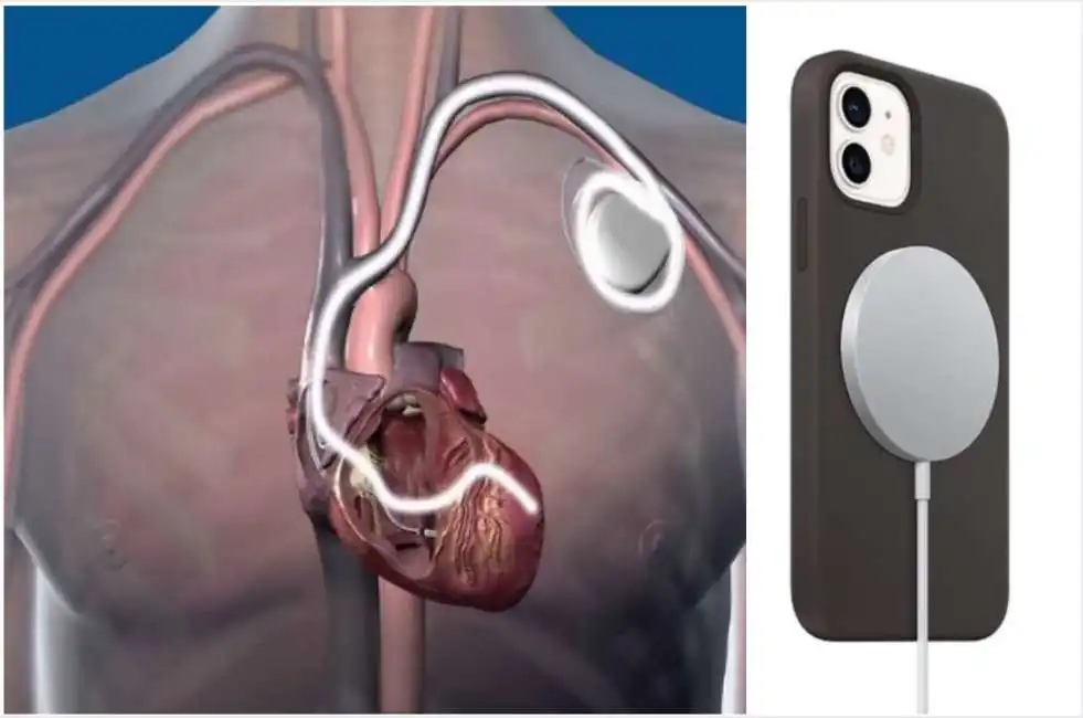 pacemaker iphone 12