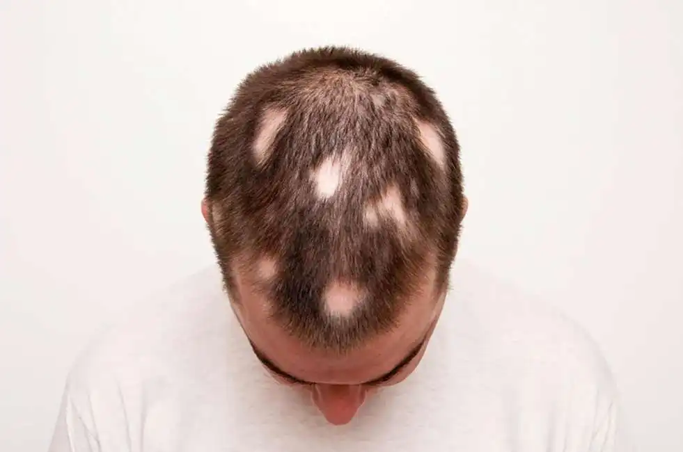 alopecia calvizie