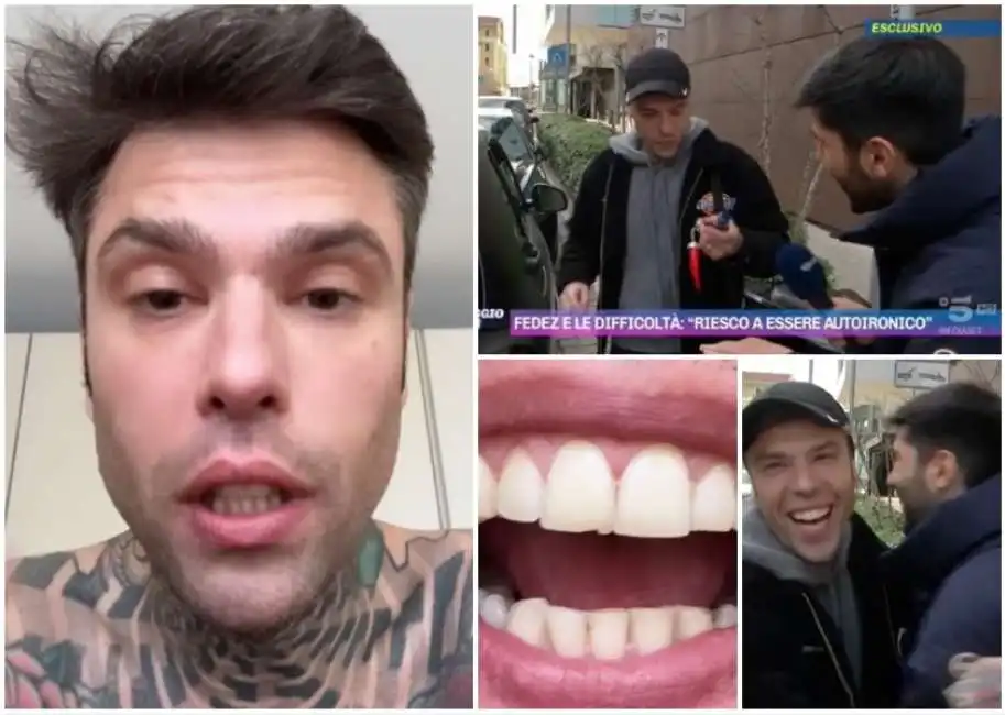 fedez dente rotto pomeriggio cinque