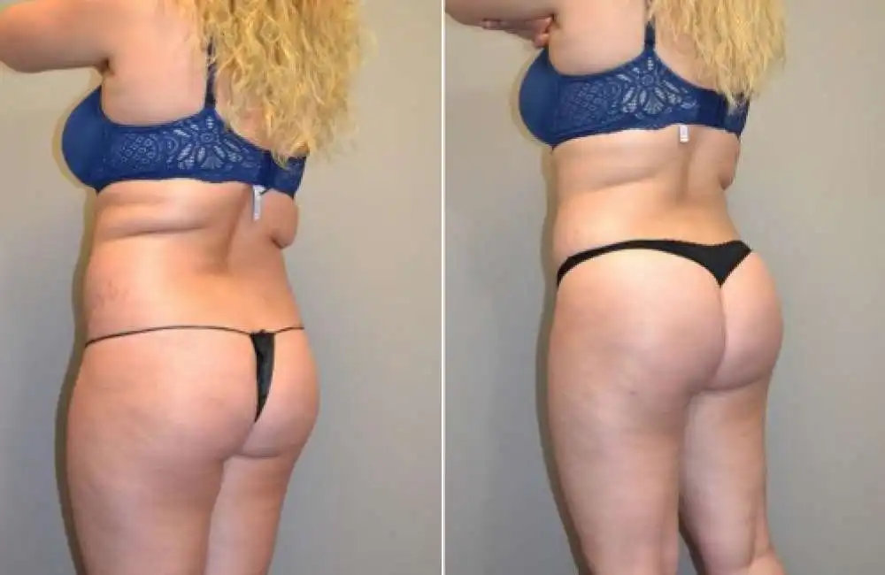 lipofilling - brazilian butt lift 