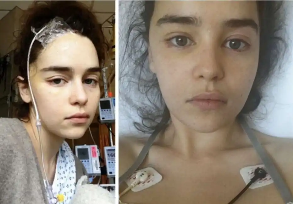 emilia clarke aneurisma ospedale