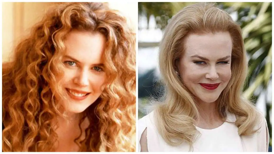 nicole kidman botox