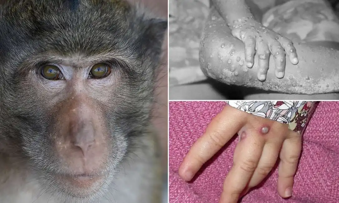 monkeypox virus vaiolo delle scimmie