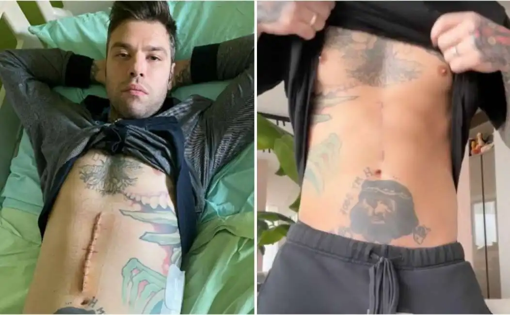 fedez cicatrice pancreas