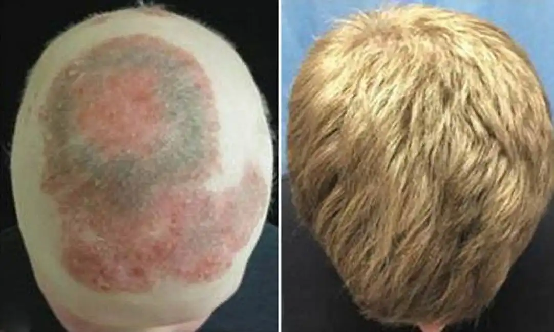 calvizie alopecia20