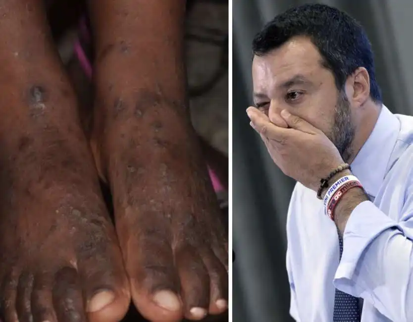 matteo salvini migranti scabbia