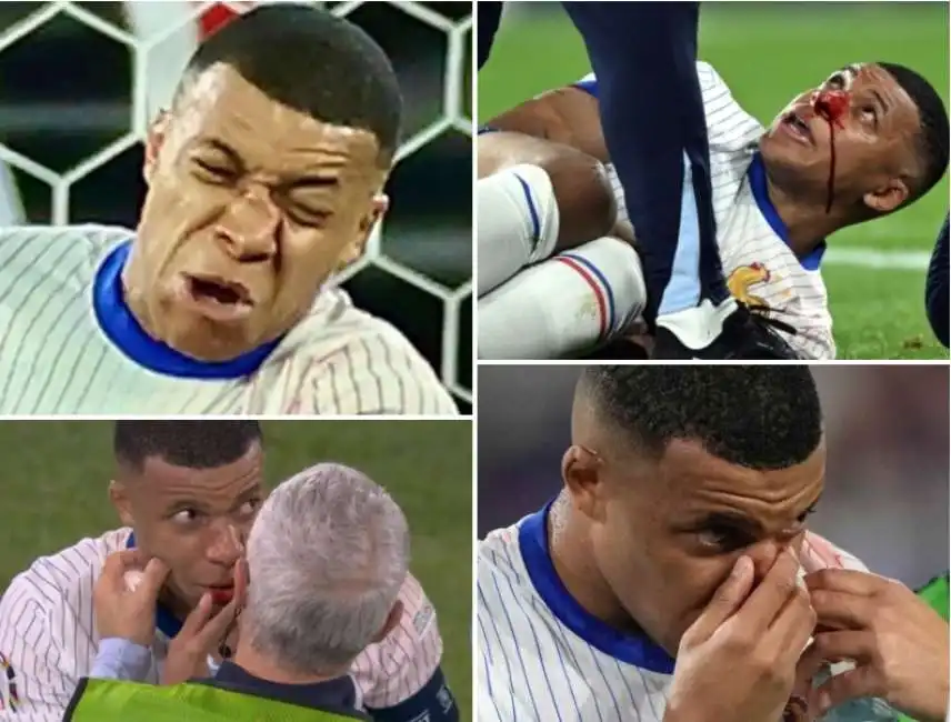 mbappe si rompe il naso nella partita contro l'austria