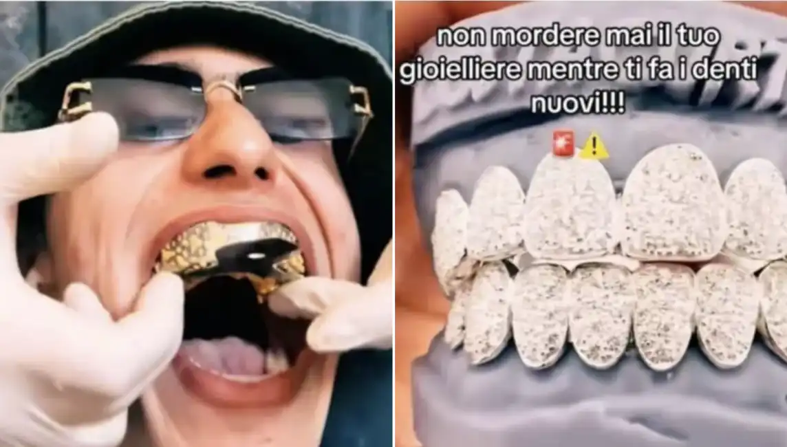 grillz achille costacurta denti diamanti 