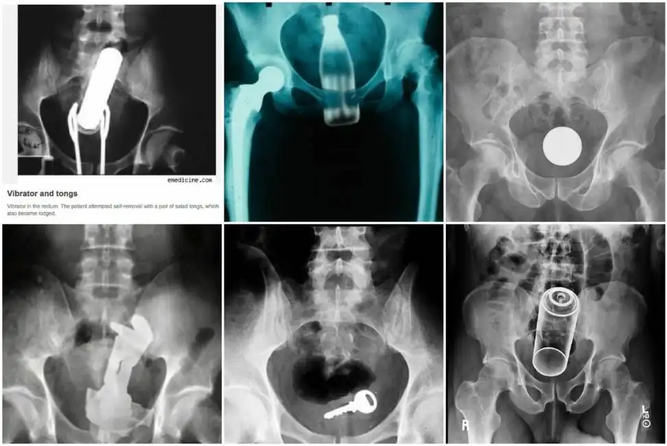 oggetti incastrati nell ano
